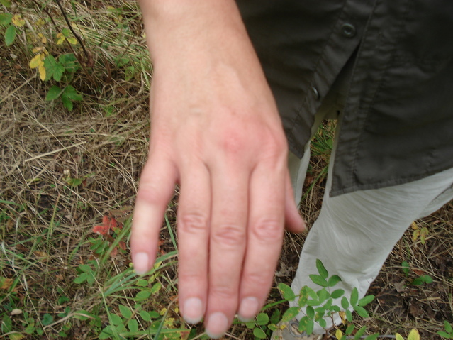 The hornet stung hand